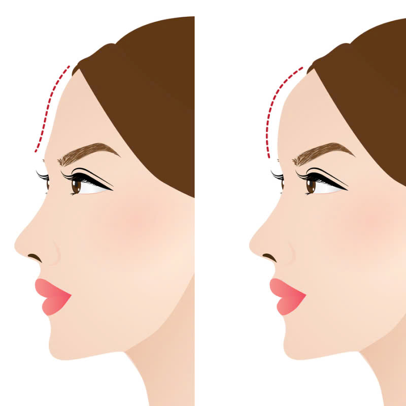 Cay mo giup tran tro nen day dan can doi hon