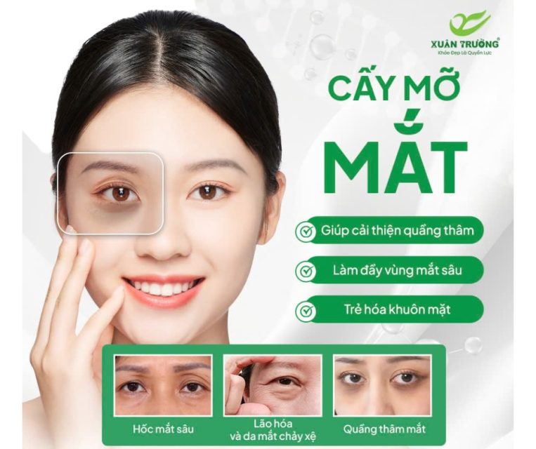 Cay mo la giai phap hoan hao giup khac phuc hoc mat trung sau va quang tham
