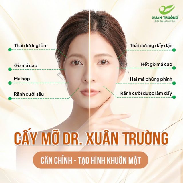 Cấy mỡ mặt