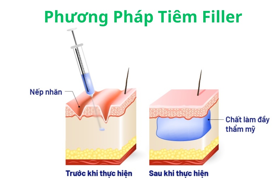 Tiem Filler Giai phap lam dep nhanh chong va hieu qua tuc thi 
