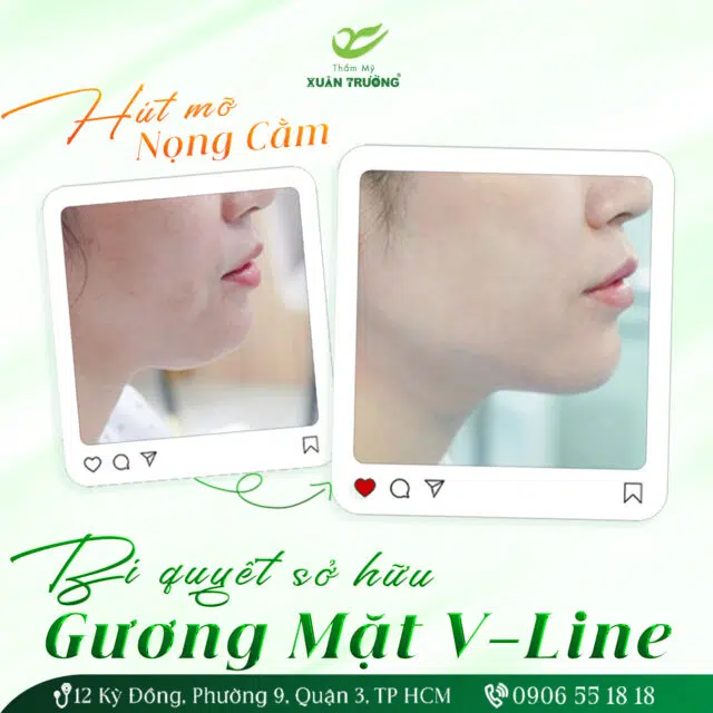 Hut mo nong cam Bi quyet so huu guong mat V line