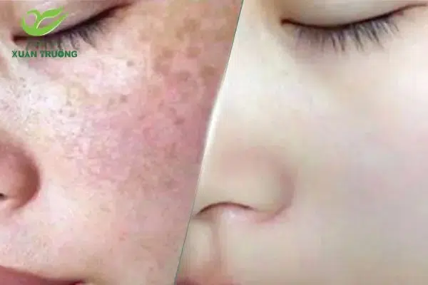 cong nghe tri nam laser toning 1 Kết quả khách hàng sau 3 buổi trị nám bằng Laser Toning