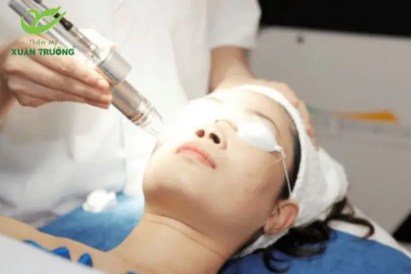 cong nghe tri nam laser toning 2 Chuyên gia đang sử dụng công nghệ trị nám Laser Toning hiện đại