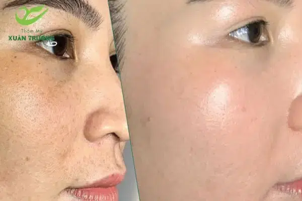 cong nghe tri nam laser toning 3 Trước và sau khi điều trị nám tại Thẩm Mỹ Xuân Trường