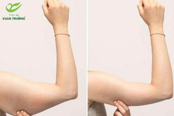 Hút mỡ bắp tay bao nhiêu tiền? So sánh hiệu quả trước và sau hút mỡ bắp tay thực tế.