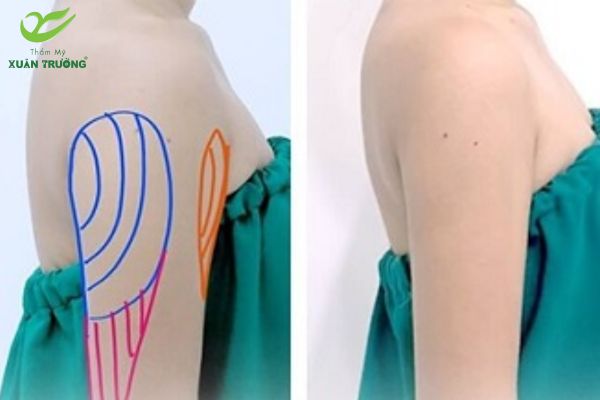 Khách hàng sau 1 tháng hút mỡ tại Thẩm Mỹ Xuân Trường