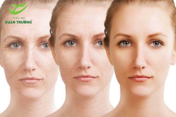 nang co hifu gia bao nhieu 2 Mức độ lão hóa da quyết định số lần và chi phí điều trị Hifu cần thiết
