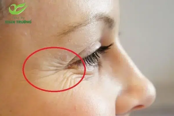 tiem botox xoa nhan duoi mat 1 Tiêm botox giúp làm mờ vết chân chim nhanh chóng, không đau