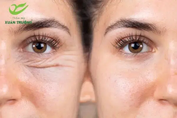 tiem botox xoa nhan duoi mat 3 Hiệu quả rõ rệt sau 3–5 ngày tiêm botox xóa nhăn