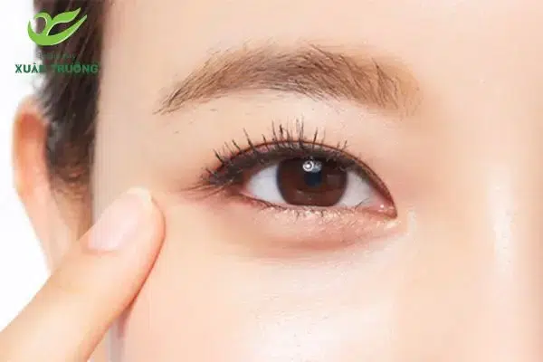 tiem botox xoa nhan duoi mat 4 Vẻ ngoài trẻ trung, tự tin hơn sau khi tiêm botox đuôi mắt