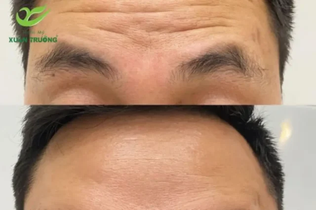 Peel da trán chống nhăn, làn da căng mịn và rạng rỡ hơn.