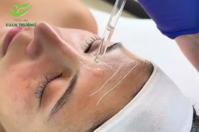 Trải nghiệm peel chuyên sâu giúp giảm nếp nhăn hiệu quả