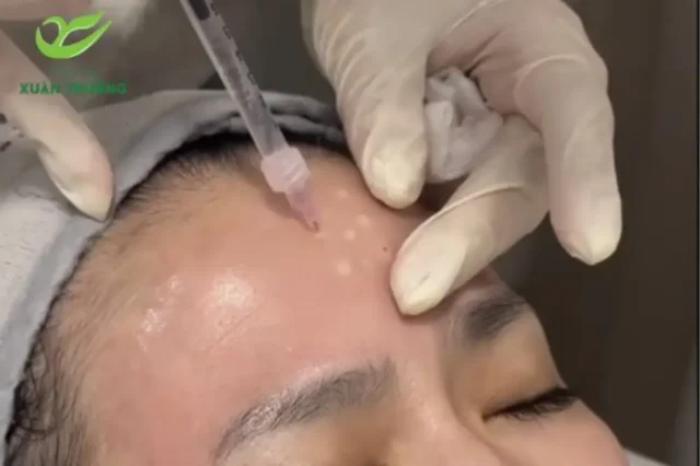 Peel da trán an toàn, tái tạo collagen, cho da săn chắc