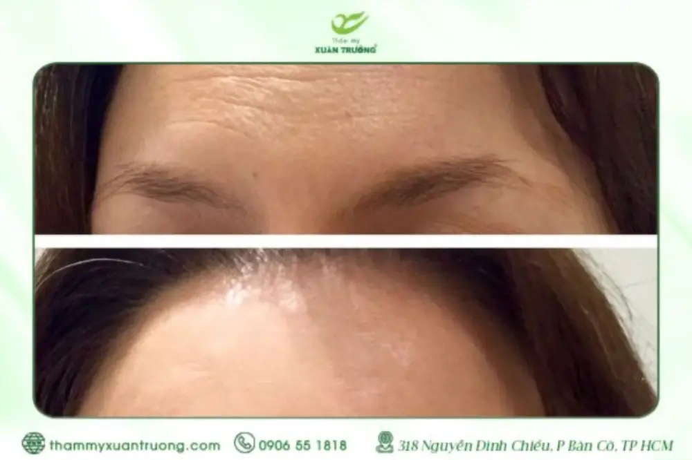 Peel Da Trán Chống Nhăn – Bí Quyết Để Làn Da Mịn Màng