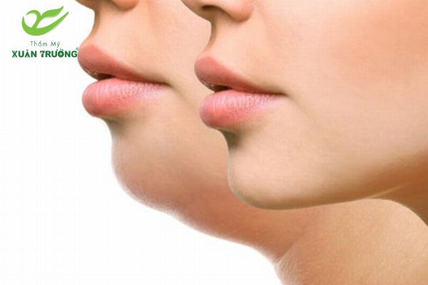 Tiêm tan mỡ nọng cằm giúp gương mặt thon gọn tự nhiên