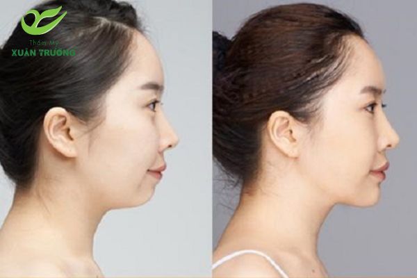 Kết quả thẩm mỹ trước và sau khi tiêm tan mỡ cằm