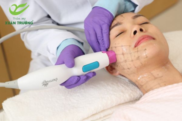 Trẻ hóa da bằng Thermage FLX cải thiện rõ rệt độ đàn hồi da