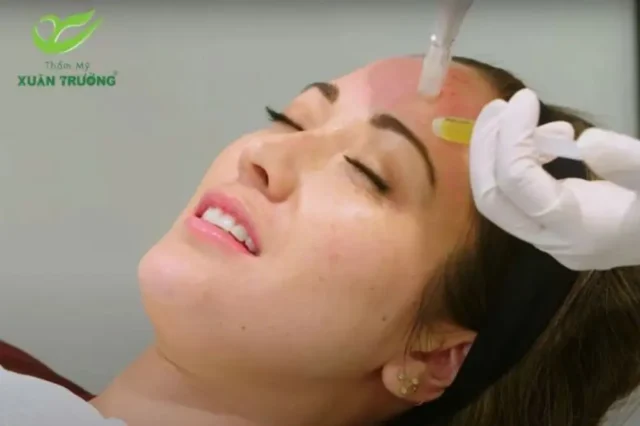 Trẻ hóa vùng trán bằng PRP mang lại làn da mịn màng