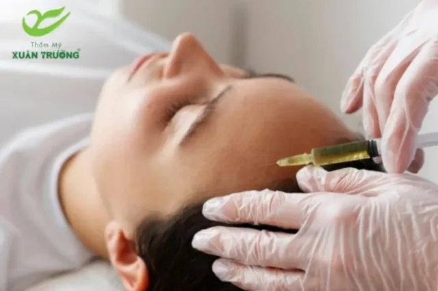 Hiệu quả trẻ hóa vùng trán bằng PRP giúp giảm nếp nhăn rõ rệt
