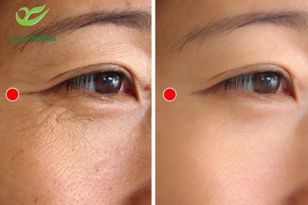 So sánh trước và sau khi xóa nhăn vùng mắt thực tế