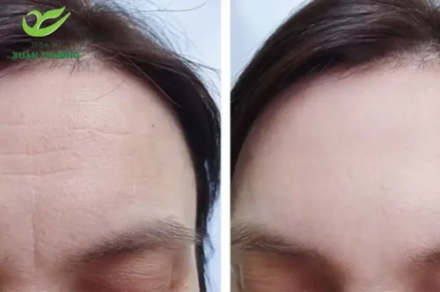 Xóa vết nhăn trán bằng Botox hiệu quả, an toàn, mang lại gương mặt tươi trẻ