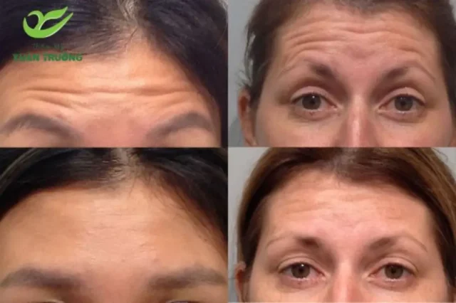 Kết quả tự nhiên, giảm nếp nhăn rõ rệt sau vài ngày tiêm Botox