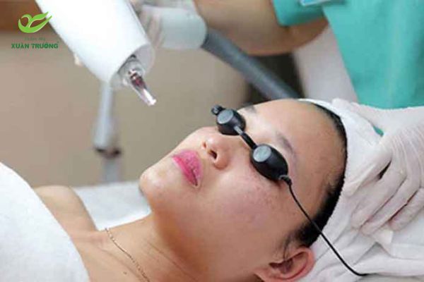 ban laser tri tham 1 Quy trình bắn laser trị thâm giúp da sáng mịn