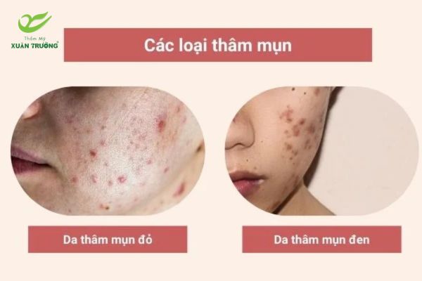 ban laser tri tham 2 Các loại da và tình trạng phù hợp để bắn laser trị thâm