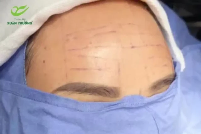 Căng da trán nội soi giúp xóa nhăn và trẻ hóa tự nhiên.