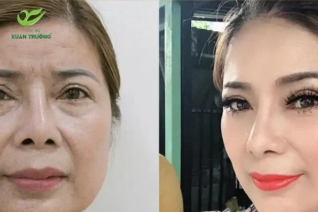 Khách hàng tự tin hơn sau quá trình căng da trán nội soi tại Thẩm Mỹ Xuân Trường