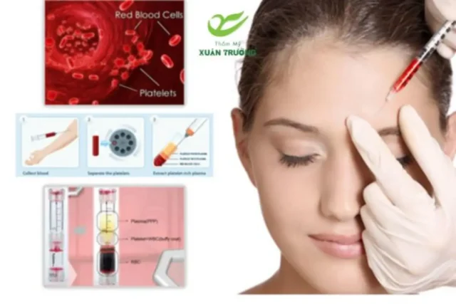 cay PRP 3 PRP kích thích collagen, cải thiện nếp nhăn và làm sáng da