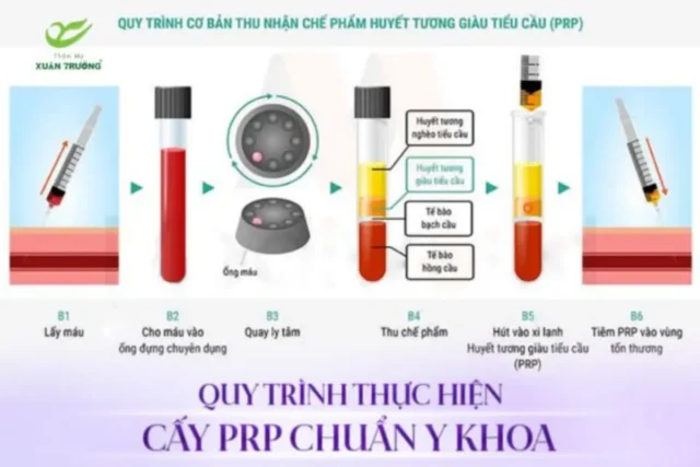 cay PRP cang bong da 3 Quy trình cấy PRP chuẩn y khoa, nhẹ nhàng và an toàn tuyệt đối