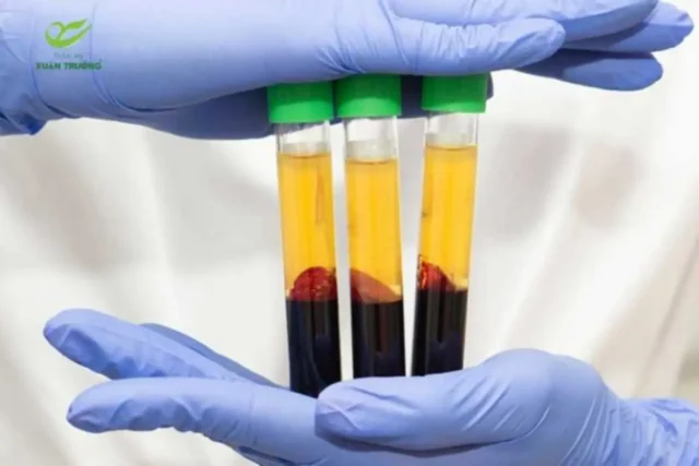cay PRP gia bao nhieu 1 Các yếu tố ảnh hưởng trực tiếp đến cấy PRP giá bao nhiêu
