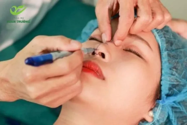 Quy trình nâng mũi cấu trúc hiện đại, giảm đau và an toàn