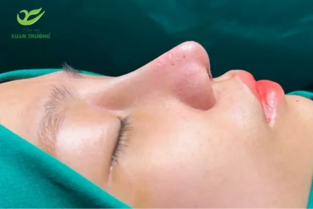 Hồi phục nhanh chóng sau nâng mũi cấu trúc, dáng mũi tự nhiên