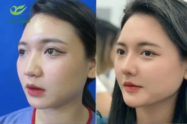 Kết quả nâng mũi cấu trúc đẹp tự nhiên, hài hòa từng đường nét