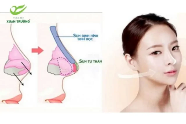 Mô phỏng kỹ thuật nâng mũi cấu trúc bằng sụn tự thân