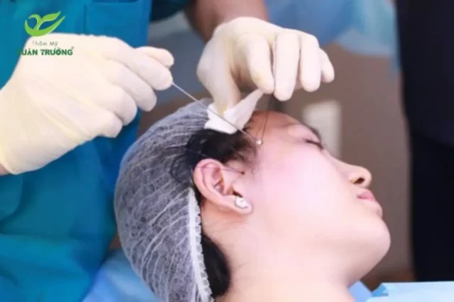 Bác sĩ đang thực hiện kỹ thuật nâng trán bằng chỉ sinh học