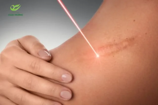 tri seo loi bang laser 1 Công nghệ laser hiện đại điều trị sẹo lồi an toàn
