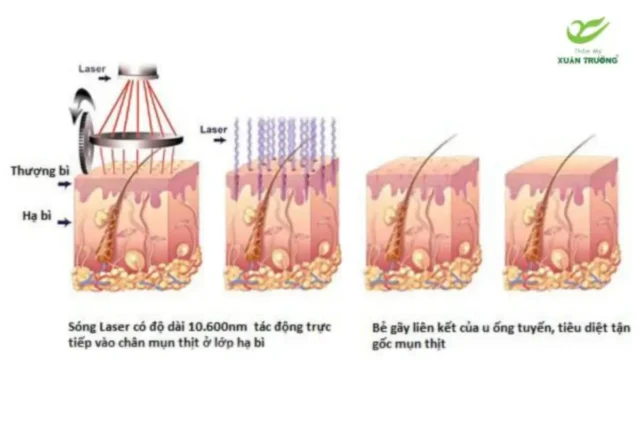 tri seo loi bang laser 3 Quy trình từng bước trị sẹo lồi bằng công nghệ laser