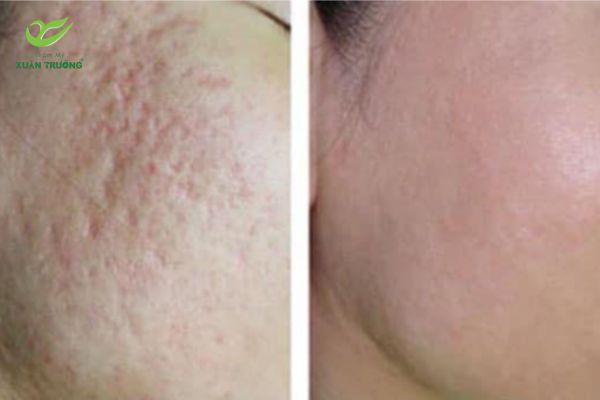 Làn da căng mịn, đều màu sau điều trị laser