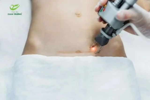 xoa seo bang laser bao nhieu tien 1 Công nghệ laser giúp cải thiện sẹo rỗ, sẹo lõm an toàn