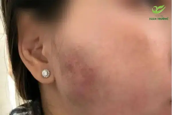 Biến chứng tiêm filler vào mạch máu gây tắc nghẽn