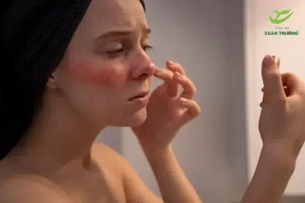 Vùng da đổi màu do tắc mạch khi tiêm filler vào mạch máu