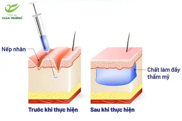 cac loai filler 1 Các loại filler giúp làm đầy, trẻ hóa da và tạo đường nét tự nhiên