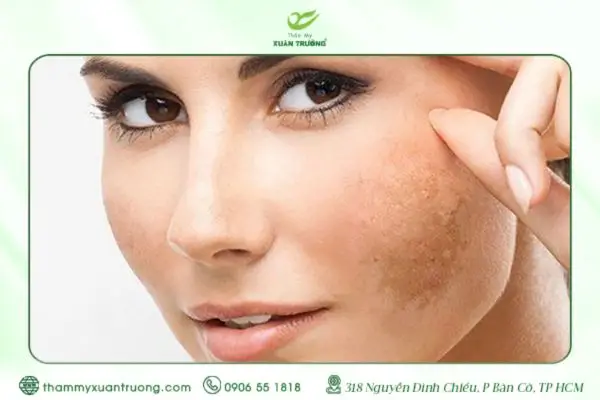 5 Cách Trị Nám Da Mặt Lâu Năm Hiệu Quả Từ Thiên Nhiên