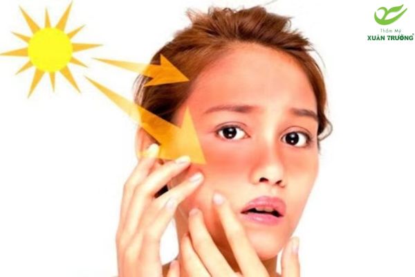 cach tri tan nhang 1 Tia UV và nội tiết tố là nguyên nhân chính gây tàn nhang