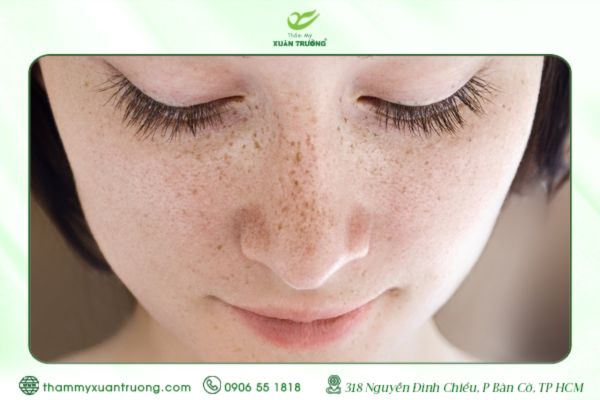Cách Trị Tàn Nhang Hiệu Quả Và An Toàn Ngay Tại Nhà
