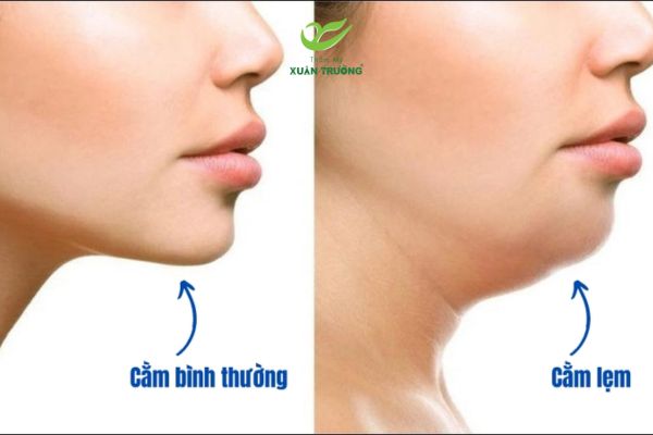 cam lem 1 So sánh khuôn mặt bình thường và khuôn mặt có cằm lẹm rõ rệt