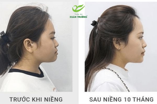 cam lem 2 Bệnh nhân trước và sau khi niềng răng cải thiện dáng cằm hiệu quả